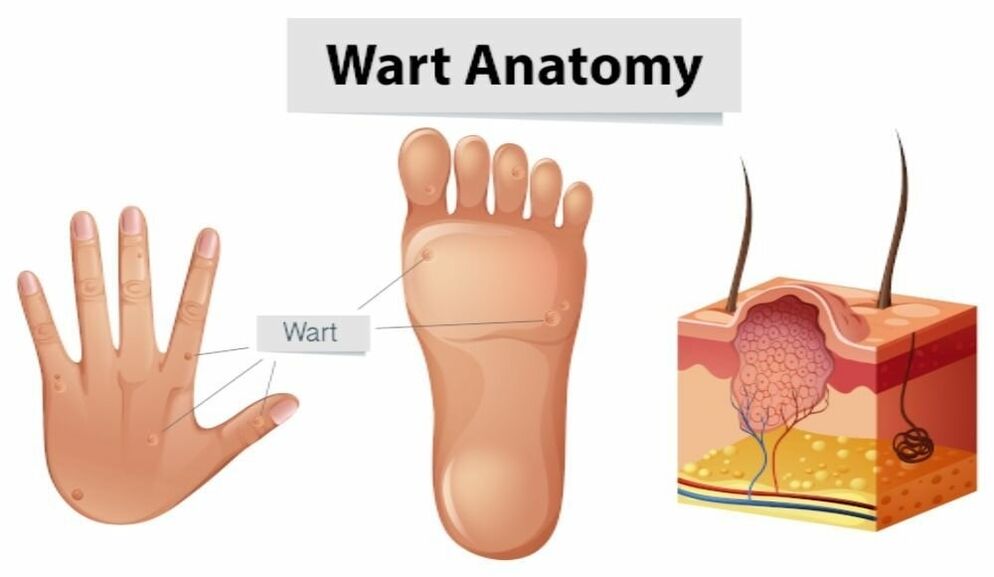 Successfully remove warts along with root using Removio