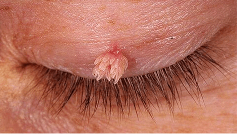 Papilloma