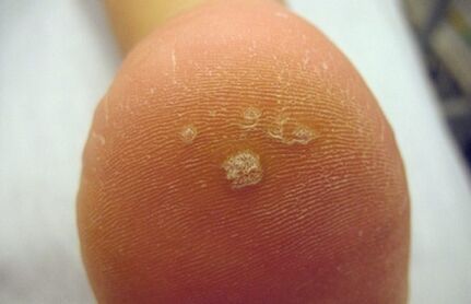 How to recognize pierce warts