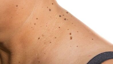 How to get rid of papilloma in the neck