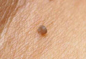 Clinical picture of papilloma