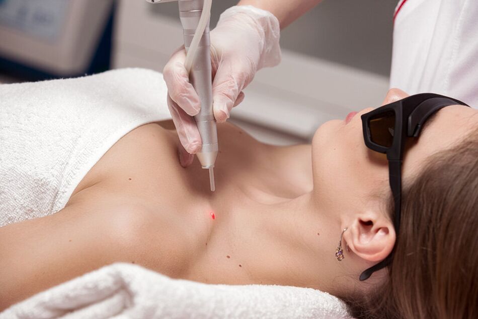 Removal of laser papilloma