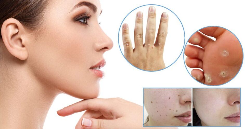 The method of removal of papillomas