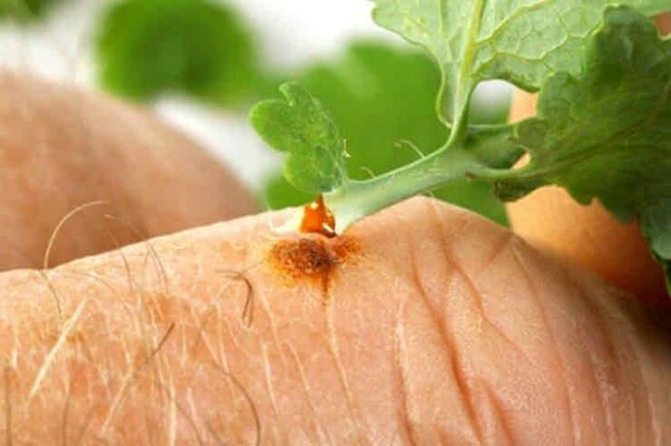 How to get rid of papilloma with folk remedies