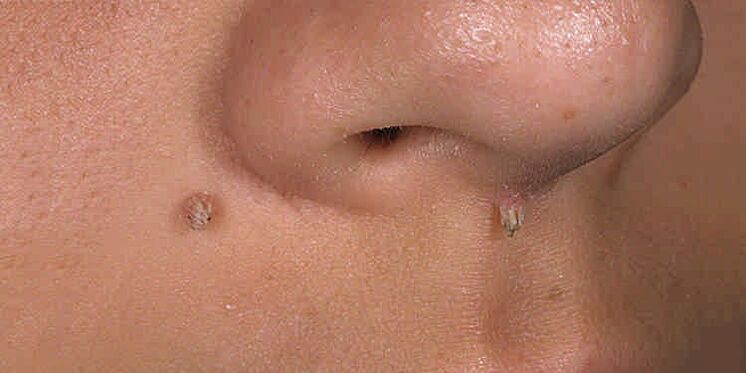 Reason -as a papilloma appearance