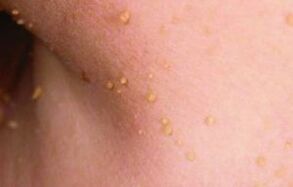 Reason -as a papilloma appearance in the body