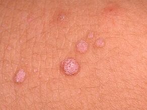 How to get rid of papillomas in the body