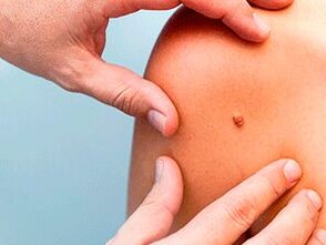 The reason for the appearance of papilloma in the body