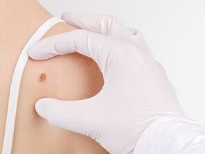 What is the dangers of having papilloma in the body