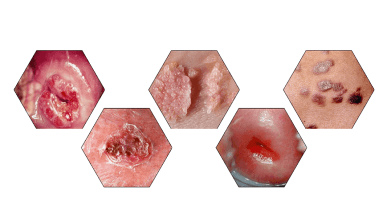 Why are papillomas dangerous