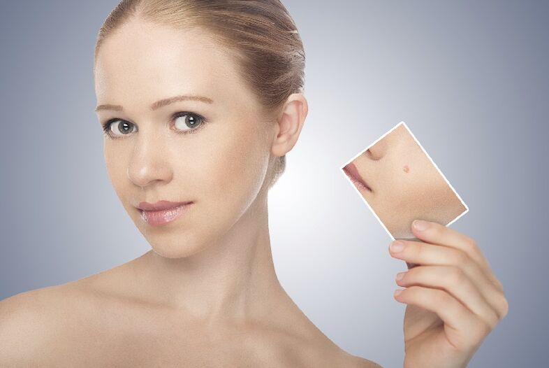 how to get rid of papilloma yourself at home