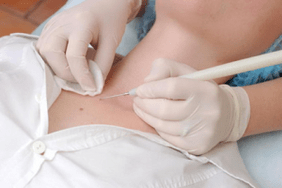 how to remove papilloma