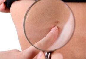 the main cause of papilloma