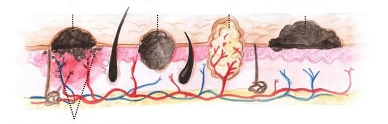 types of papillomas in the human body