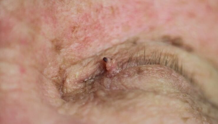 papilloma on the eyelid how to get rid of it