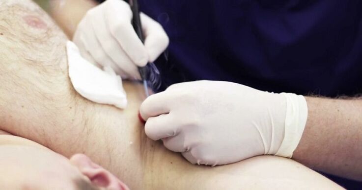 professional method to remove papilloma on the human body