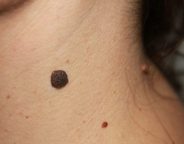 Flat papilloma on the neck