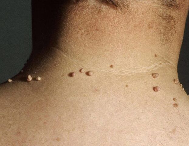 Papilloma on male neck
