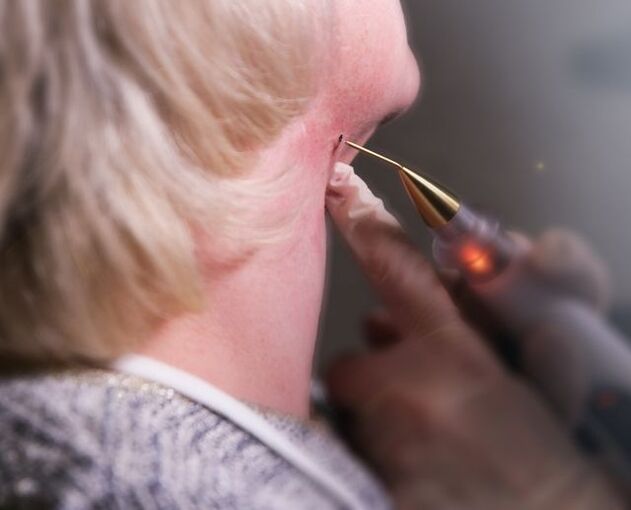 The process of removing papillomas on a woman's neck