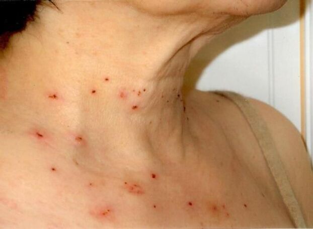 Treatment results for papilloma on the neck