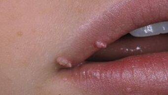 Papilloma on the lips