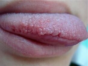 Papilloma on the tongue