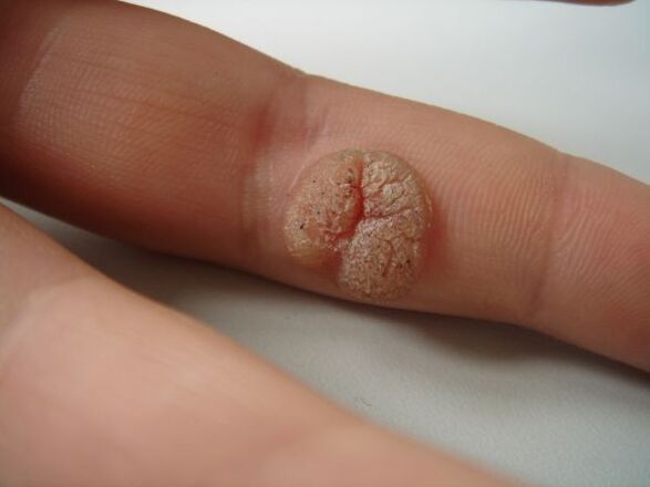 Complications of self-removal of papilloma