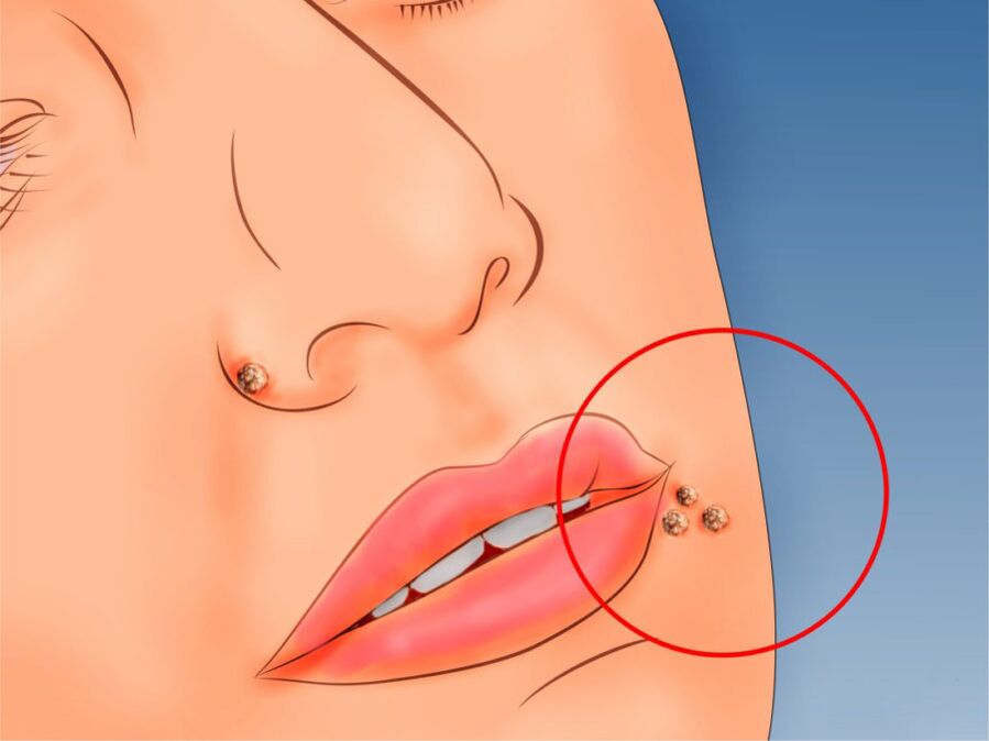 Papilloma on the face