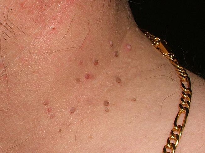 Papilloma on the neck