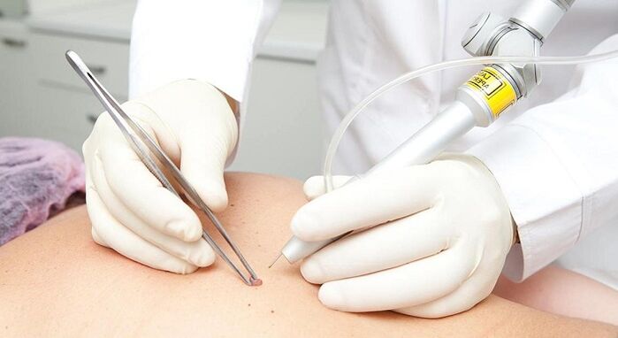 papilloma laser removal for papillomavirus