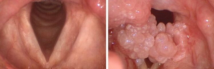 clean throat and papilloma in the pharynx